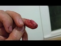 Broken finger tip