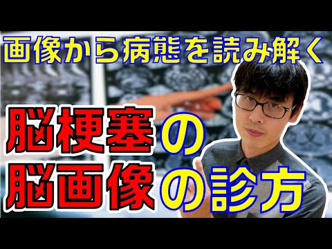 【脳梗塞の臨床症状の理解がグッと深まる！】脳梗塞の脳画像を診るポイントを解説します！