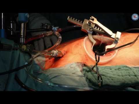 Video-atlas on minimally invasive mitral valve surgery—the Mohr technique