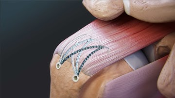 FiberTak® SpeedBridge™ Rotator Cuff Repair