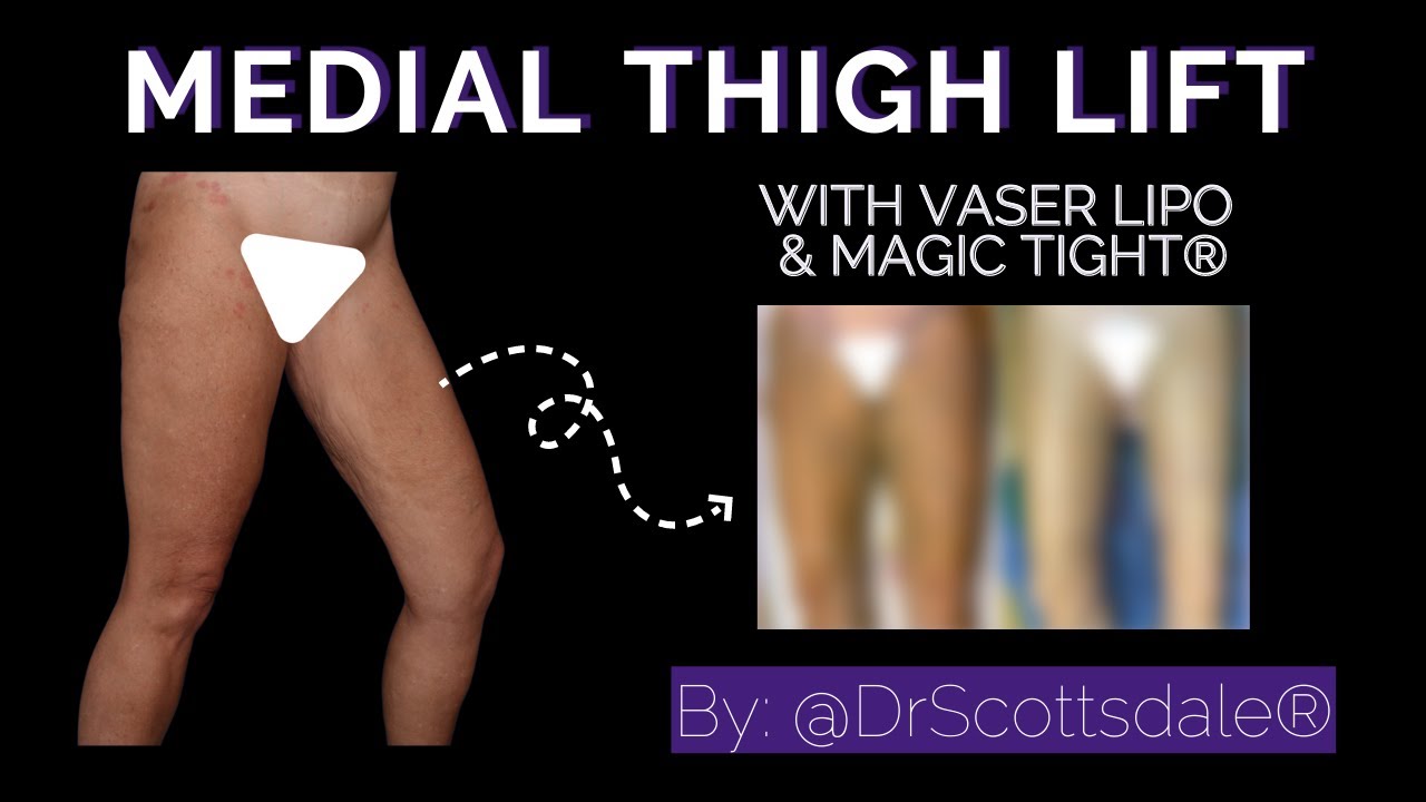 Medial Thigh Lift with Magic Tight® & Vaser Lipo by DrScottsdale YouTube