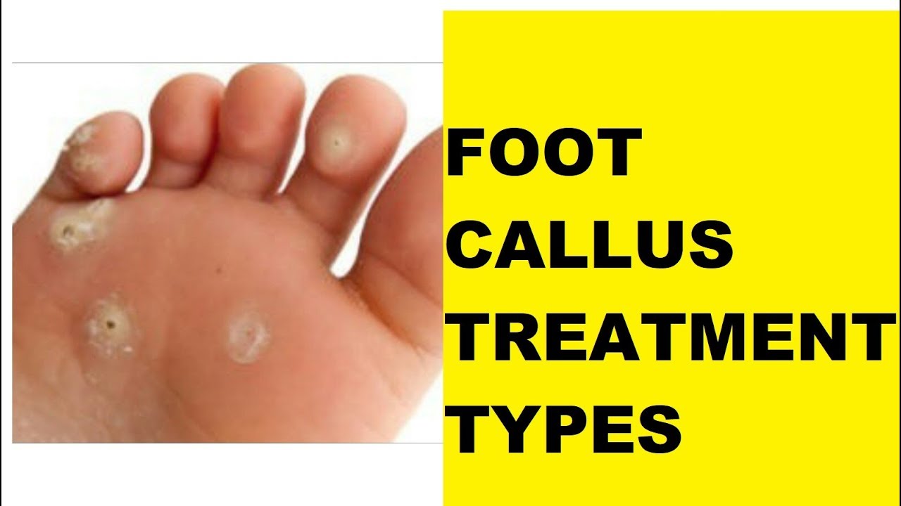 FOOT CALLUS TYPES OF TREATMENT | AYAK NASIRI TEDAVİ ÇEŞİTLERİ - YouTube