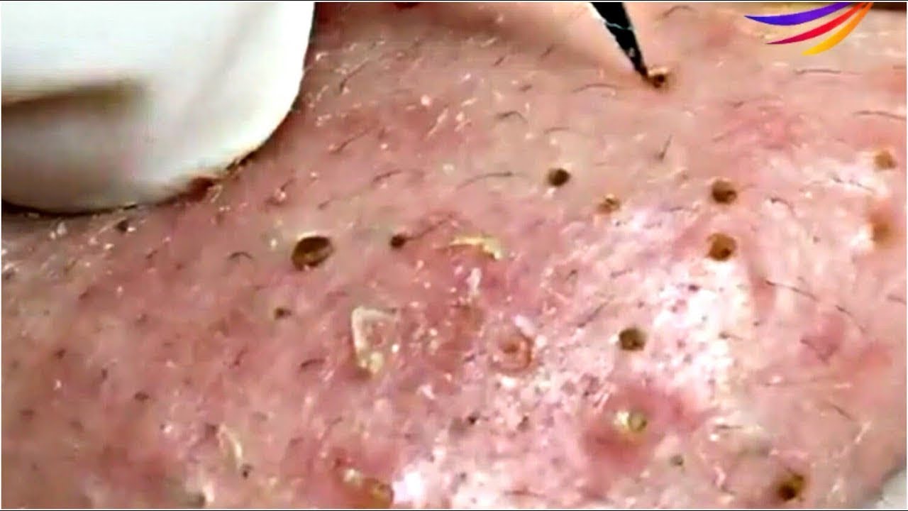 Acne Treatment Blackhead Extractions Popping 68 Youtube