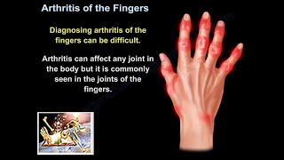 Arthritis Of The Fingers  Everything You Need To Know  Dr. Nabil Ebraheim
