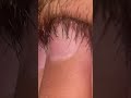 ASMR ingrown hair removal hair cut hair style