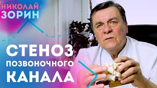 Стеноз позвоночного канала