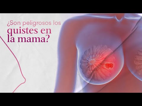 Video: 3 formas de tratar los quistes mamarios
