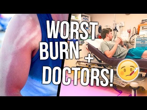 THE WORST SUNBURN EVER & EMERGENCY DOCTORS VISIT!!