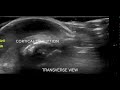 Osteomyelitis Right 1st Toe