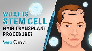 What Is Stem Cell #hairtransplant  Procedure? #stemcelltransplant