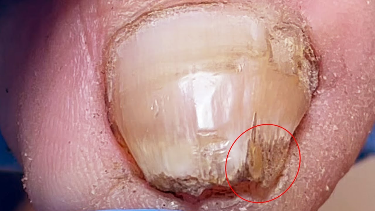 trim-super-thick-toenails-thinning-layer-by-layer-youtube