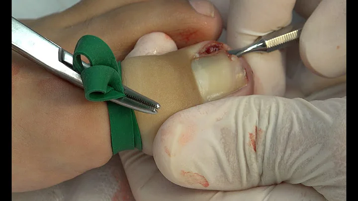 Melvin's Toenail Fights Back... Time for Phenol!