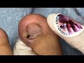Ep_6098 Foot nails skin removal 👣 ออกมาชุดใหญ่ 😊 (clip from Thailand)