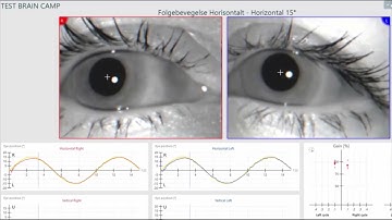 Videonystagmograpgy (VNG) Brain Camp