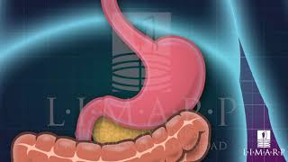 Intragastric Balloon Tijuana México - LIMARP / DR. POMPA