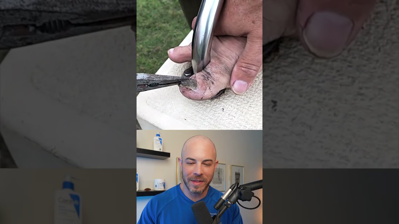 Derm Reacts To HORRENDOUS Toenail Removal Dermreacts Doctorreacts Toenailremoval