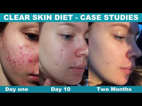 Change Your Diet, Clear Your Acne