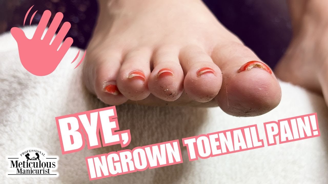 Here's how to prevent injury to lifted thick toenails: ( link in  bio)  #meticulousmanic