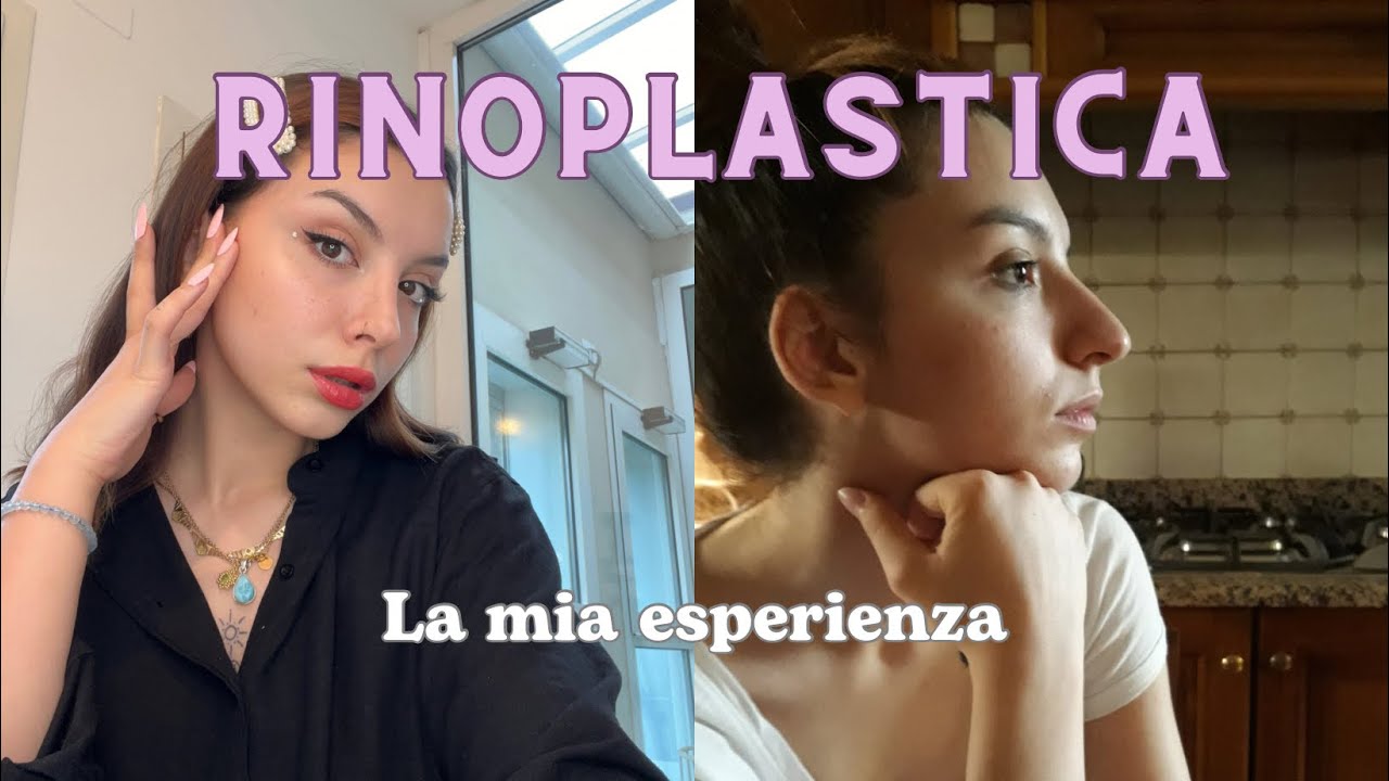 RINOPLASTICA / la mia esperienza 👀