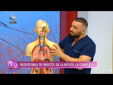 Teo Show (12.08.2020) - Intepaturile de insecte: de la iritatii, la complicatii! "Sfatul doctorului"