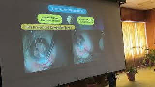 Moorfields Safer Surgery System, trabeculectomy