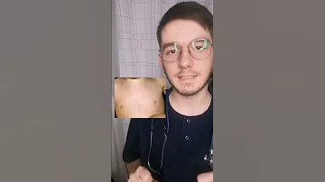 Что такое детская розеола
