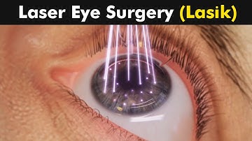 How Laser Eye Surgery (Lasik) is Performed? | 3D Animation (Urdu/Hindi)