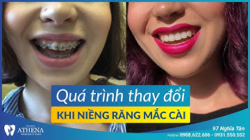 Quá trình thay đổi khi niềng răng mắc cài | Video timelapse | Nha khoa Athena