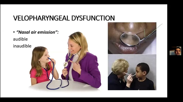 VPI- Velo Pharyngeal Incompetence, diagnosis and management