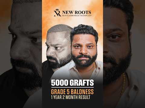 5000 Grafts Hair Transplant in Pune | Hair Transplant Cost in Pune | Marathi #hair #shorts
