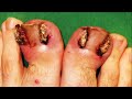 Worst Ingrown Toenails Ever on YouTube!