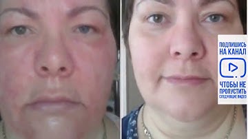 Инсульт, Гипертония _ Отзывы о применении ЛЕДЕНЦОВ APL/Аккумулированные драже APLGO