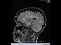 MRI Results Reading