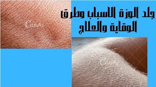 جلد الوزة (الاسباب و طرق الوقاية و العلاج)