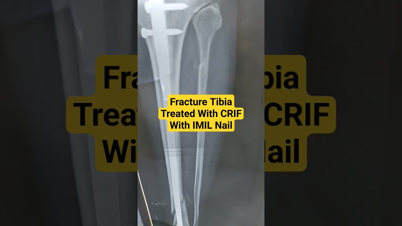 Distal tibia metaphyseal fractures: Which is better, intra-medullary nailing  or minimally invasive plate osteosynthesis?