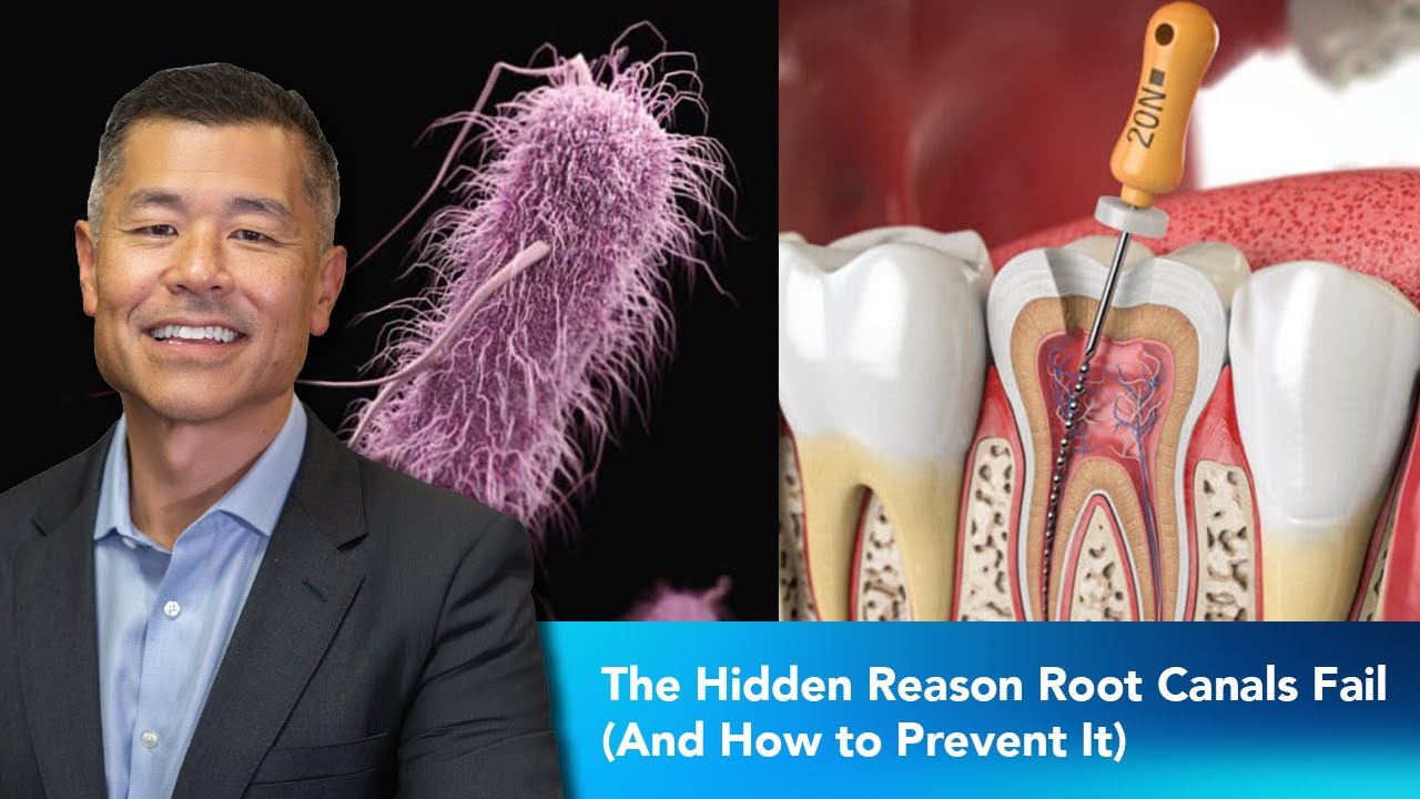 The Hidden Reason Root Canals Fail (And How to Prevent It) | Dentist 2 Dentist