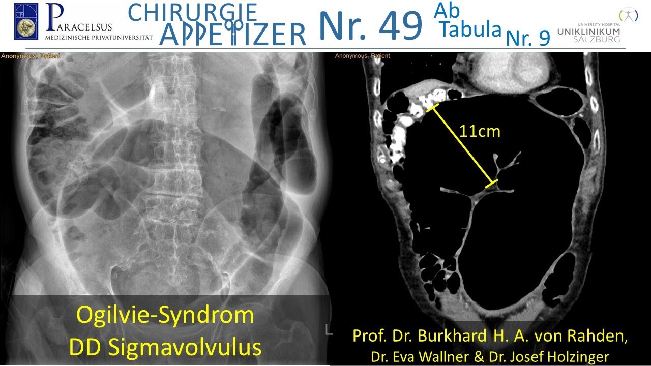 OgilvieSyndrom DD Sigmavolvulus CHIRURGIE APPetizer Nr.49/ AB TABULA
