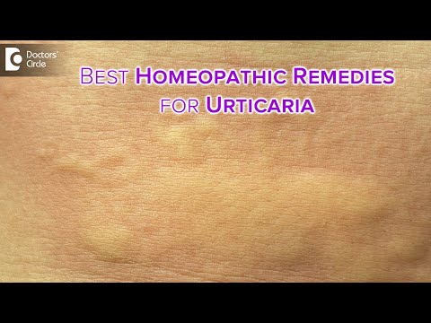 Detailed causes of  URTICARIA or HIVES |  Homeopathic Remedies -Dr.V.Bhagyalakshmi | Doctors&rsquo; Circle