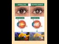 "Normal vs Clouded Lens: Key Differences Explained!" #NormalLens #CloudedLens #VisionHealth #Healthy