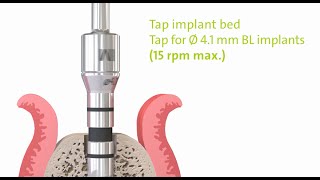 Straumann® PURE Ceramic Implant Monotype: Step by Step.