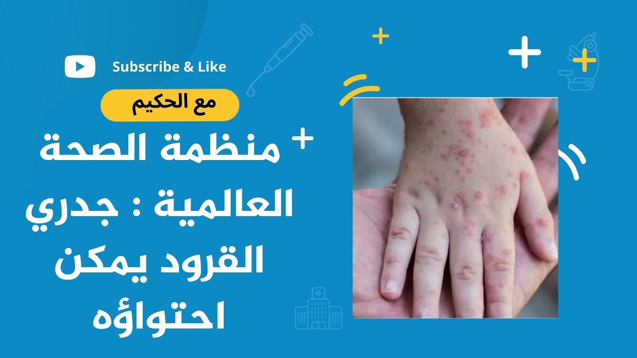 منظمة الصحة العالمية : جدري القرود يمكن احتواؤه