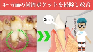 4mm,5mm,6mmの歯周ポケットを掃除し、改善回復するセルフケア法