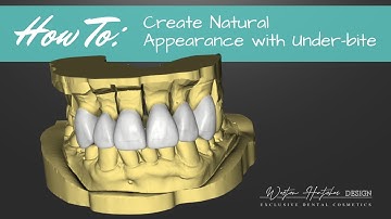 Sirona InLab 18: Designing Teeth with Under-bite