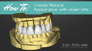 Sirona InLab 18: Designing Teeth with Under-bite
