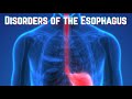 Disorders of the Esophagus (updated 2023) - CRASH! Medical Review Series