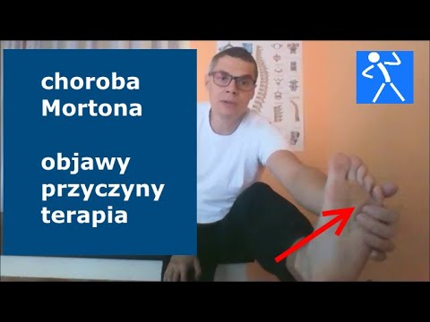 Wideo: Jak leczyć nerwiaka Mortona i co to jest