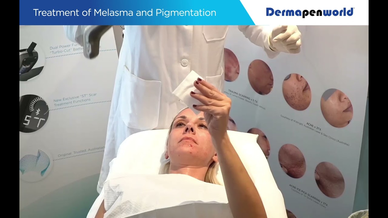 Dr Andrew Treatment Demo Melasma