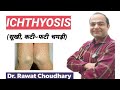 Ichthyosis ( सूखी-फटी चर्म )