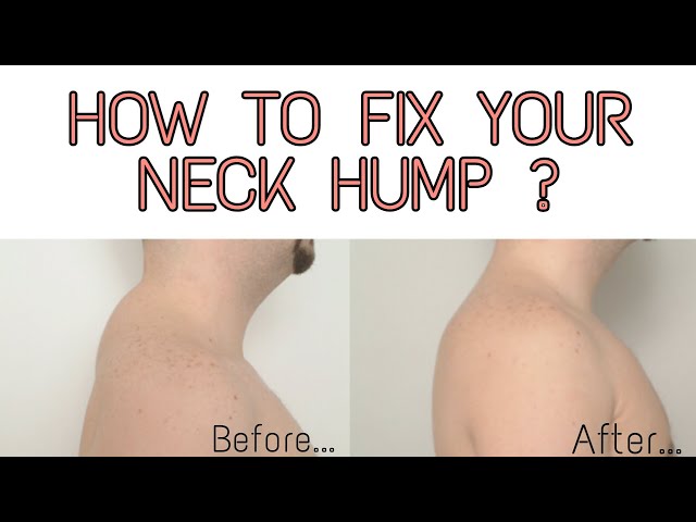 Neck Hump, How to Get Rid of Buffalo Hump, EP 23, Groove With Garima  Bhandari, Fit Tak