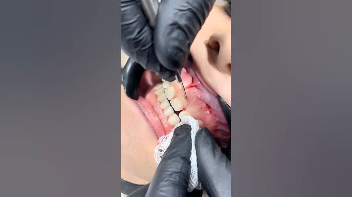 The SECRET Behind Fixing A Gummy Smile! 😁🦷